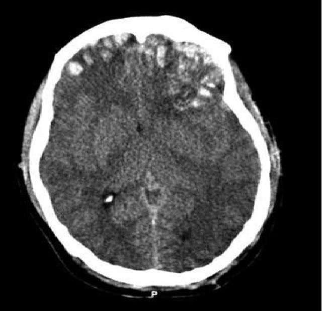 the-legal-definition-of-catastrophic-brain-injury-after-an-ontario